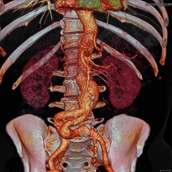 CT Angiography Pelvis